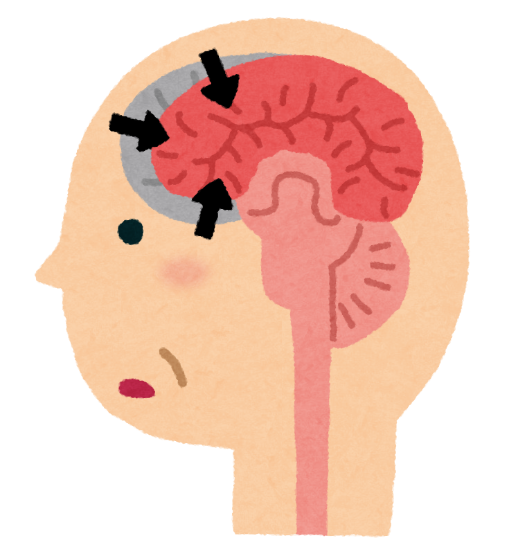 Illustration: a simple side view cutaway of a person's head, facing left, with the brain visible. There is a grey copy of the red and pink brain behind it, and three arrows pointing inward at the smaller pink brain, indicating that it is shrinking.